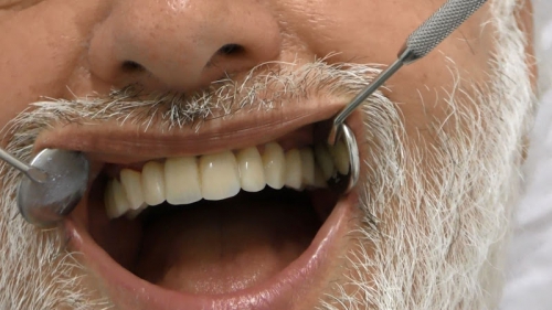 Foto Implantologia Modena Network | Impianti dentali poco osso senza osso prezzi | Zigomatici Circolari senza gengiva