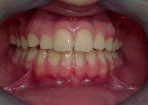 Foto Liberatore Dr. Gianluigi Studio Dentistico PROTESI ,IMPLANTOGIA ,ORTODONZIA , 3914329788
