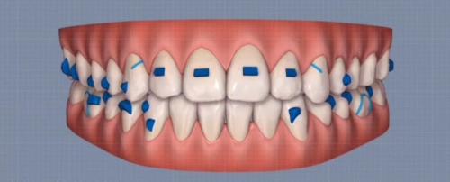Foto Dental Leggera