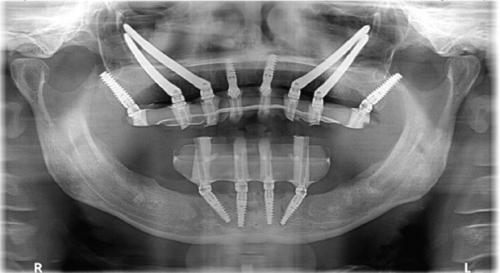 Foto Implantologia dentale