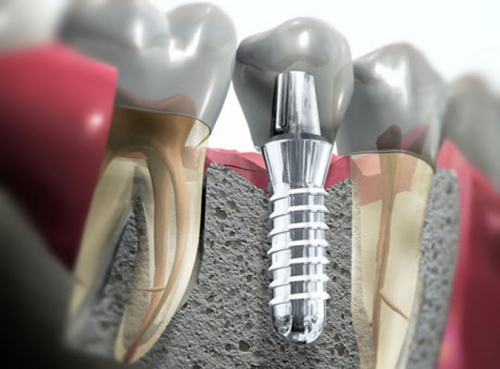 Foto Biodent Napoli - Dr Azzurra Di Cecilia - Invisalign Provider