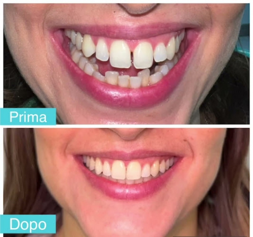 Foto Studio Dentistico Scorca INVISALIGN | Dentista Bari | Sbiancamento | Impianti Dentali | Apparecchio Invisibile Foto Studio Dentistico Scorca INVISALIGN | Dentista Bari | Sbiancamento | Impianti Dentali | Apparecchio Invisibile